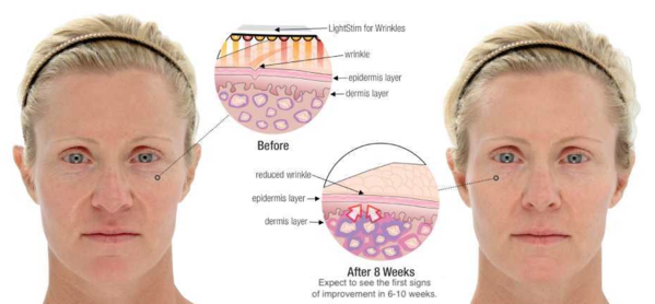 LightStim for Wrinkles